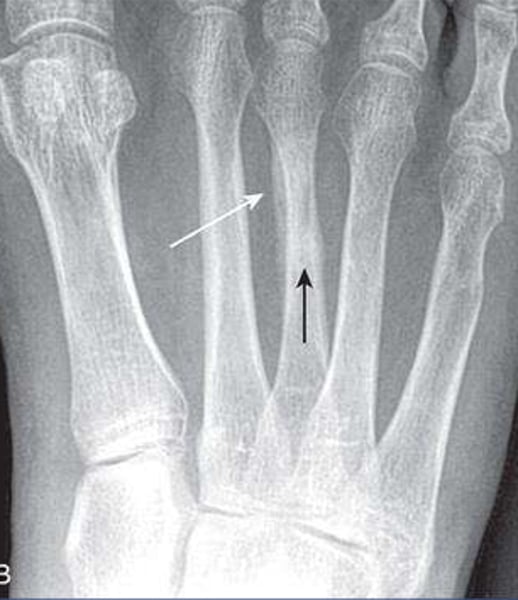 <p>What is the name of this fracture?</p>