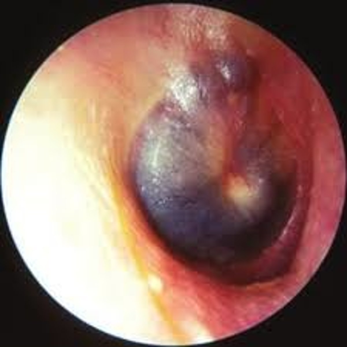 <p>Blood behind eardrum</p>