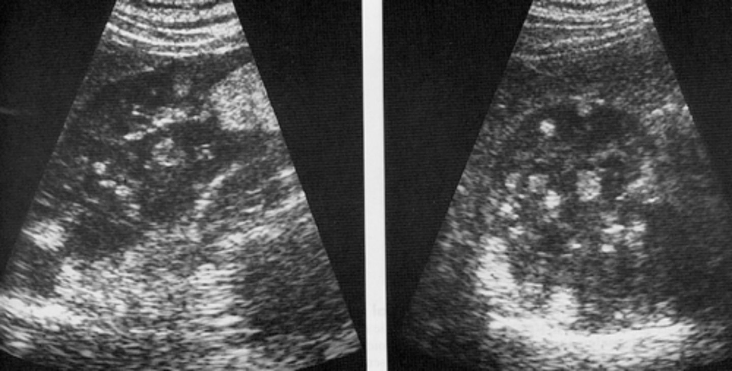 <p>-multiple renal cysts</p><p>-angiomyolipoma</p><p>-may become large</p>