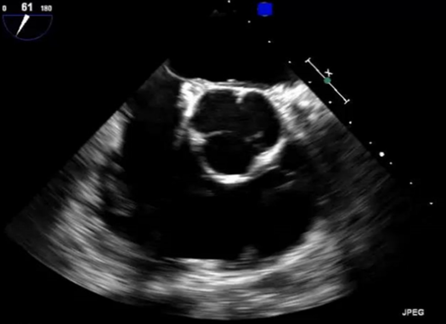 <p>right coronary cusp</p>