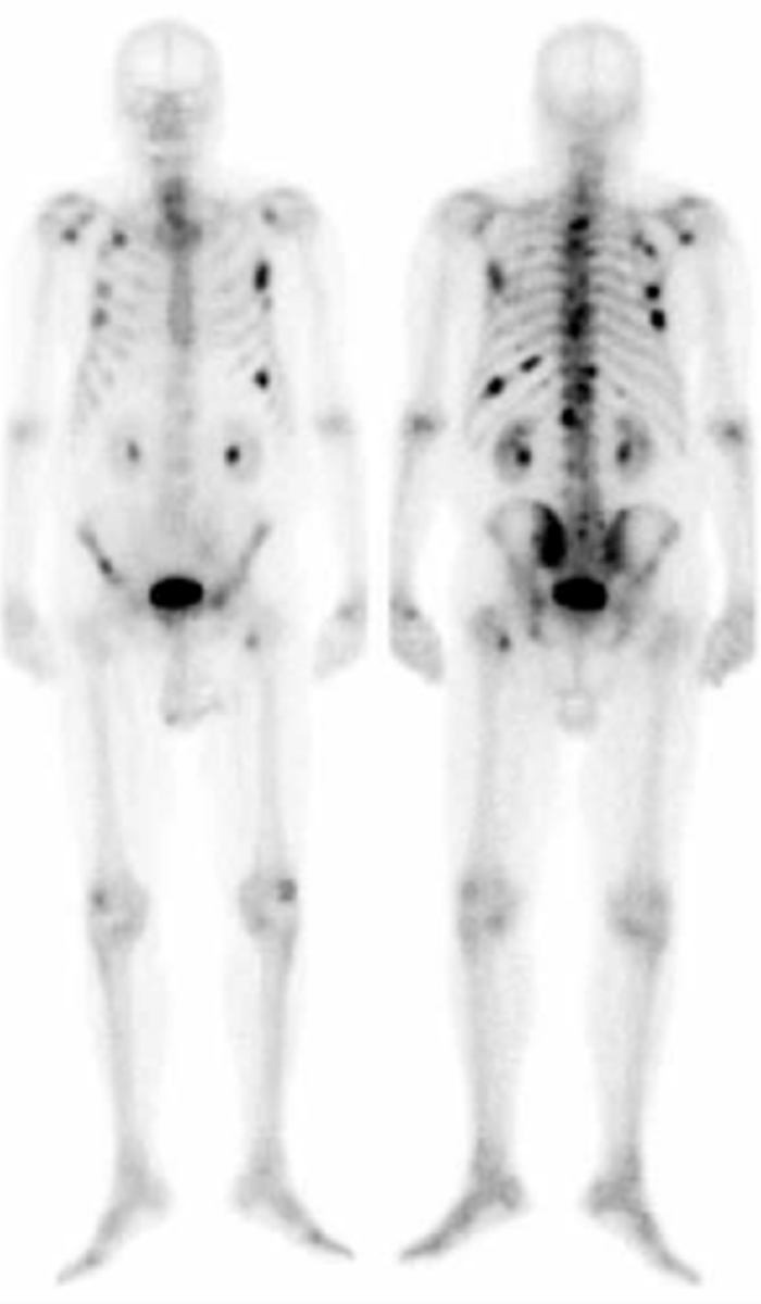 <p>the patient has widespread metastatic disease</p>