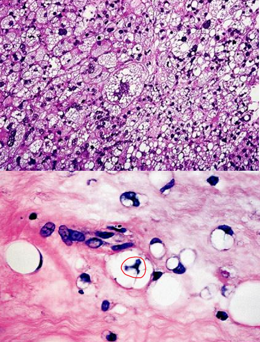 <p>one of the <strong><mark data-color="green">most common adult sarcomas</mark></strong> that are <strong><mark data-color="blue">derived from primitive mesenchymal cells</mark></strong> &amp; <strong><span style="color: red">arise deep in the proximal extremities or retroperitoneum</span></strong> of <strong><mark data-color="green">people in their 50s &amp; 60s</mark></strong> </p><ul><li><p>well-differentiated &amp; pleomorphic types</p></li></ul>