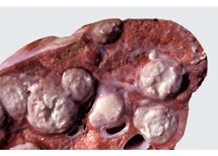 <p>a collection of neutrophils mixed with cell debris and a fibrous capsule that eventually walls off infection and requires lancing </p>