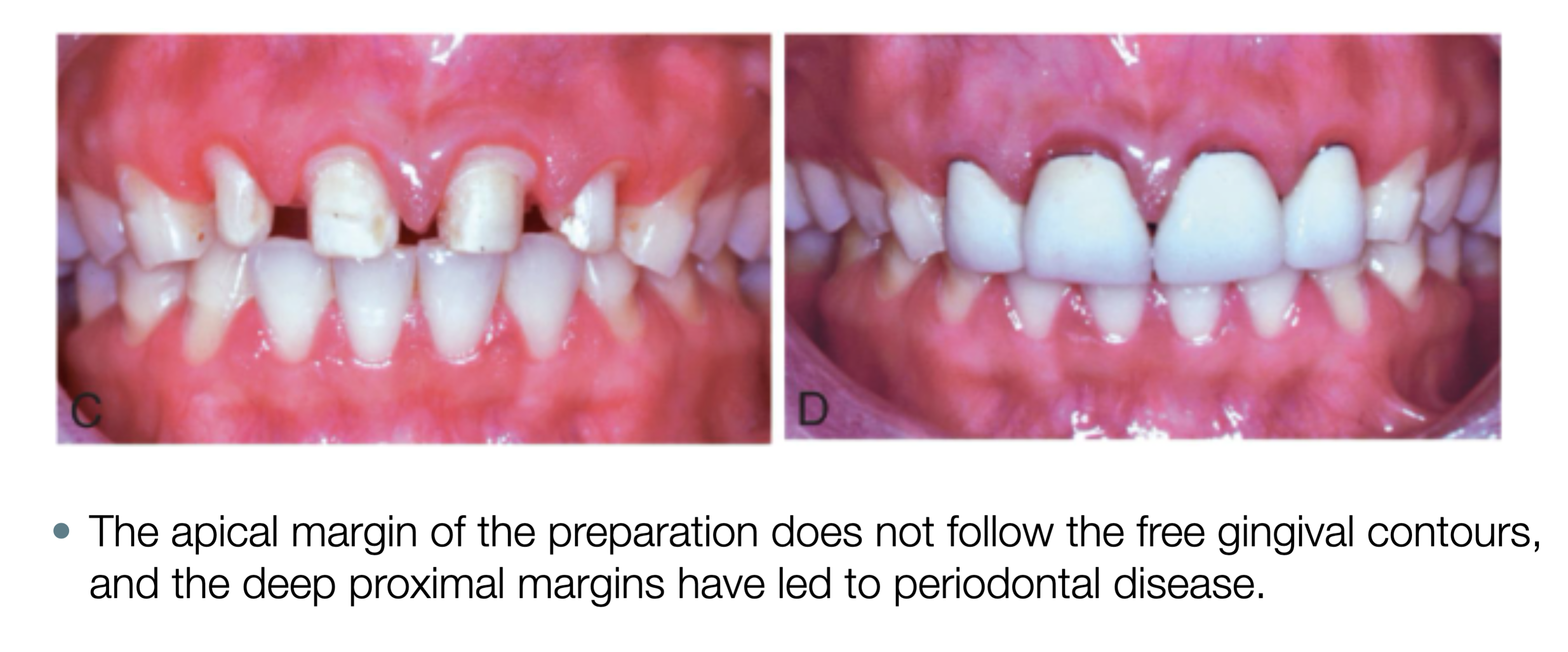 <p>gingival inflammation, clinical attachment loss, and bone loss&nbsp;</p>