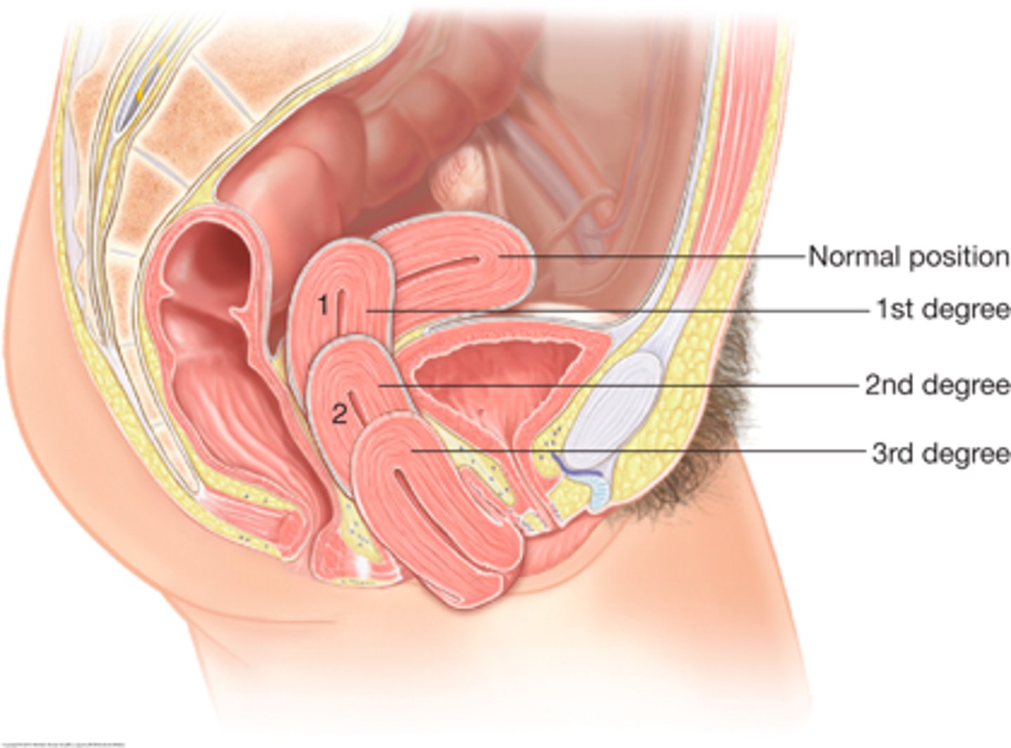 <p>results from weakness of the supporting structures of the pelvic floor; associated with a cystocele and rectocele</p>