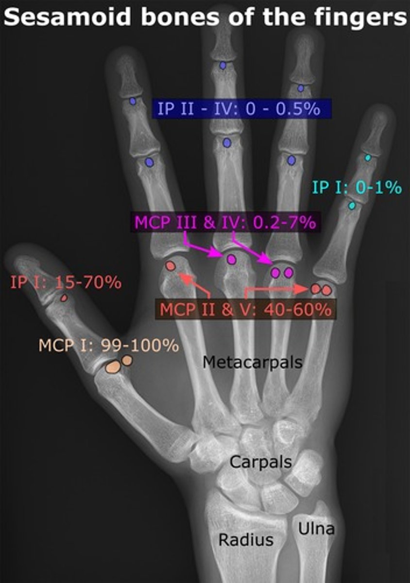 <p>A sesamoid bone is typically present adjacent to the head of the first metacarpal, but sesamoids may also appear adjacent to the heads of other metacarpal bones.</p>