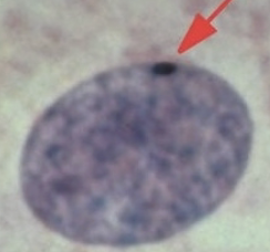 <p>An inactivated X chromosome in the somatic chromosome (ONLY IN FEMALE)</p><ul><li><p>seen as a densely packed spot in the nucleus of the cell</p></li><li><p>dosage compensation</p></li></ul><p></p>