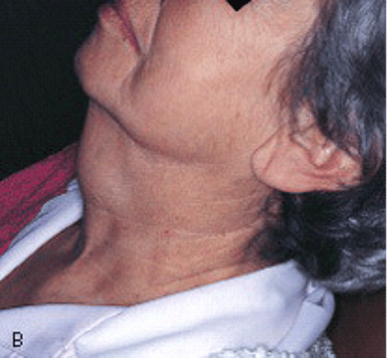 <p>Thyroglossal duct cyst</p>