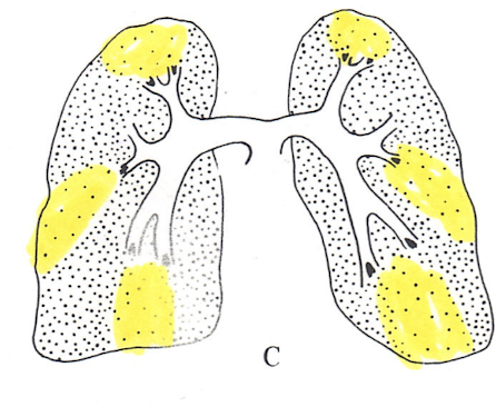 <p>Diagnosis?</p><p>Ventilation study NORMAL</p>