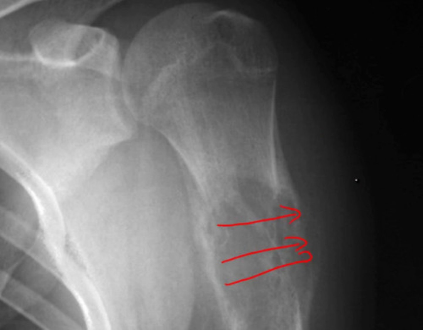 <p>Osteosarcoma</p><p>- large and tender mass</p><p>- sunburts poeriosteal rxn + Codman triangle</p>