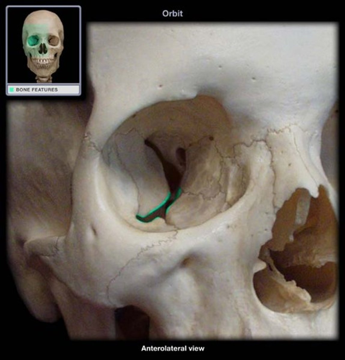 <p>Bottom part of the boomerang shape of the orbital fissure.</p>