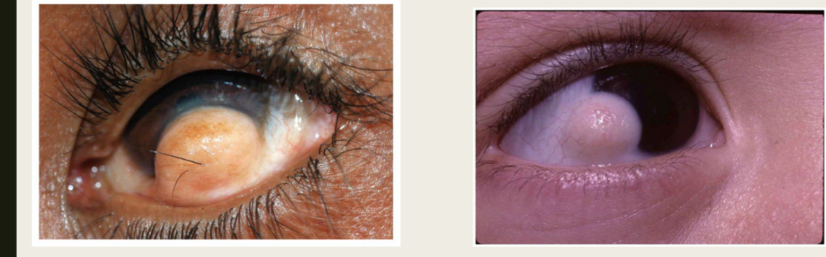 <p>Surgical—simple excision for small lesions to corneal transplants when the cornea is significantly involved.&nbsp;</p>