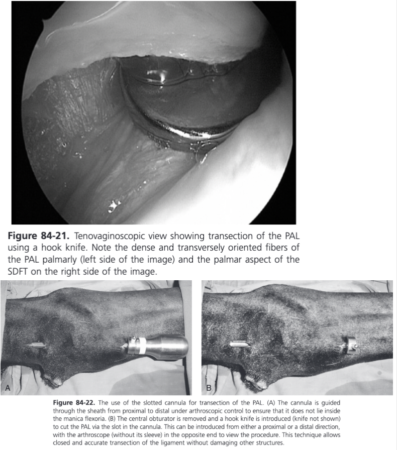<ul><li><p><span>Preferred because it is less traumatic, ensure accurate transection of only the PAL, and allows evaluation of the tendons to identify any primary causes</span></p></li><li><p><span>Performed via standard tenoscopic approach and is most easily performed using a hooked knife introduced via a proximal portal and guided to the distal end of the PAL under tenoscopic control to ensure it does not pass through the manica flexoria</span></p></li><li><p><span>Can also be performed using a slotted cannula by introducing the cannula through a proximal instrument portal and passing it out of the scope portal</span></p></li><li><p><span>A radiofrequency probe can also be used which allows precise transection and reduces hemorrhage</span></p></li></ul>