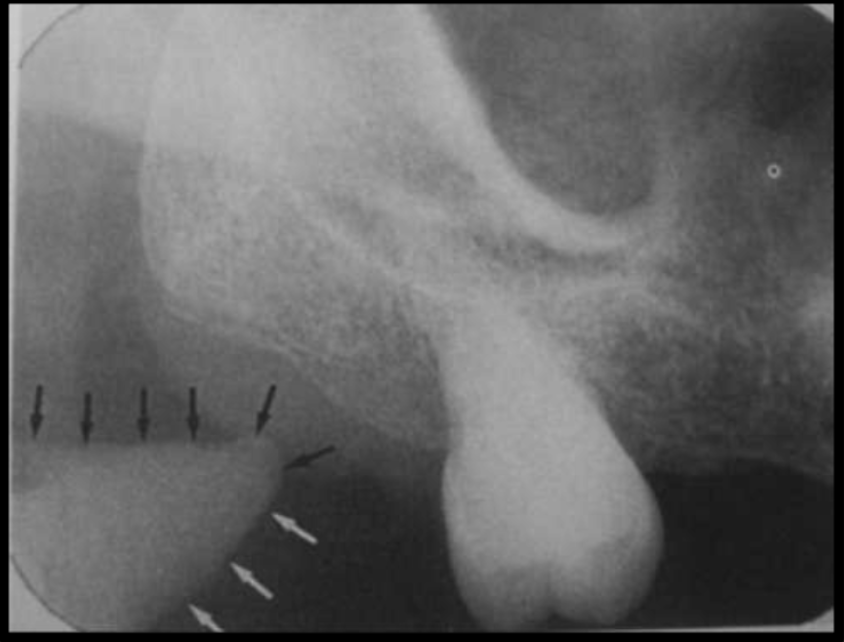 <p>-Radio-opaque</p><p>-Triangular/shark tooth shape pointing to the maxilla</p><p>-Point sits behind the maxillary molars</p>