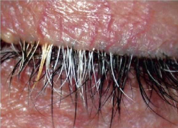 <ul><li><p>Anterior blepharitis</p></li><li><p>Vogt-Koyanagi-Harada syndrome </p></li><li><p>Vitiligo</p></li><li><p>Marfan syndrome</p></li><li><p>Tuberous sclerosis (non-cancerous tumors throughout the body) </p></li></ul><p></p>
