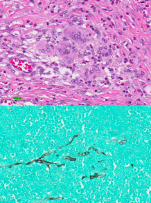 <ul><li><p><span style="background-color: transparent;"><strong><u><span>Histoplasmosis</span></u></strong></span></p><ul><li><p><span style="background-color: transparent;"><strong><span>Et: </span></strong><span>Soil-borne, Mississippi & Ohio River valleys</span></span></p></li><li><p><span style="background-color: transparent;"><strong><span>Cs:</span></strong><span> </span></span><span style="background-color: transparent; color: red;"><span>multisystemic (GI(colon), liver, spleen, lungs, eyes, bones)</span></span></p><ul><li><p><span style="color: red;">LG/SM bowel diarrhea, wt loss, fever, thickened bowel loops</span></p></li></ul></li><li><p><span style="background-color: transparent;"><strong><span>Dt:</span><u><span> Cytology</span></u></strong><span> (rectal/liver/spleen </span></span><span style="background-color: transparent; color: green;"><span>FNA</span></span><span style="background-color: transparent;"><span>), biopsy, urine ag test</span></span></p></li><li><p><span style="background-color: transparent;"><strong><span>Tx:</span><u><span> </span></u></strong><u><span>Itraconazole, fluconazole</span></u><span>, amphotericin B (≥6 months).</span></span></p></li></ul></li><li><p><span style="background-color: transparent;"><strong><u><span>Pythium insidiosum</span></u></strong></span></p></li><li><p><span style="background-color: transparent;"><strong><u><span>Gulf coast southern US</span></u></strong></span></p><ul><li><p><span style="background-color: transparent;"><strong><span>Et: </span></strong></span><span style="background-color: transparent; color: red;"><span>GI tract, granulomatous masses</span></span></p><ul><li><p><span style="color: red;">Focal or multifocal </span><span style="background-color: transparent; font-size: 1.6rem; color: red;"><span>segmental thickening</span></span></p><ul><li><p><span style="background-color: transparent; font-size: 1.6rem; color: red;"><span>Stomach, SI, colon, ± esophagus</span></span></p></li></ul></li></ul></li><li><p><strong>CS:</strong> vomiting, diarrhea, anorexia, wt loss</p></li><li><p><span style="background-color: transparent;"><strong><span>Dt: </span></strong><span>Cytology or biopsy, ELISA(antibody), PCR(antigen)</span></span></p></li><li><p><span style="background-color: transparent;"><strong><span>Tx:</span></strong><span> Sx, itraconazole + terbinafine, pred</span></span></p></li><li><p><span style="background-color: transparent;"><strong><span>Px: </span></strong><span>poor</span></span></p></li></ul></li></ul><p></p>