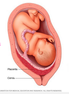 <p><strong>Placenta Previa: Background</strong></p><p>-The presence of placental tissue that extends over the _______ cervical os, which can potentially lead to severe antepartum ________, preterm birth, and postpartum hemorrhage </p><p>-Should be suspected in any pregnant woman beyond __<strong> </strong>weeks gestation who presents with __________ vaginal bleeding </p><ul><li><p>Causes bleeding when uterine ___________ or gradual changes in the cervix and lower uterine segment apply shearing forces to the inelastic _________ attachment site </p></li></ul><p>-For women who have not had a second-trimester ultrasound, bleeding after 20 weeks of gestation should prompt an ultrasound ______ a digital vaginal examination is performed</p><ul><li><p>Palpation of the placenta can cause severe ___________</p></li></ul><p></p>