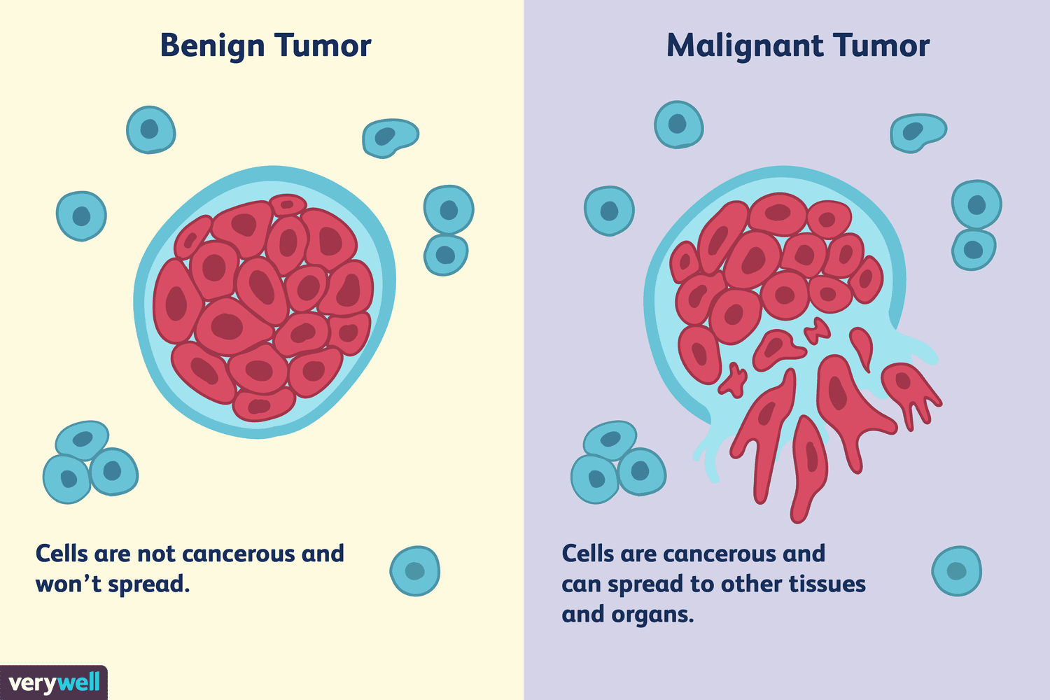 <ol><li><p>May arise in ANY TISSUE</p></li><li><p>Grows locally - does not invade other tissue </p></li><li><p>Can be surgically removed with no recurrence </p></li></ol><p></p>