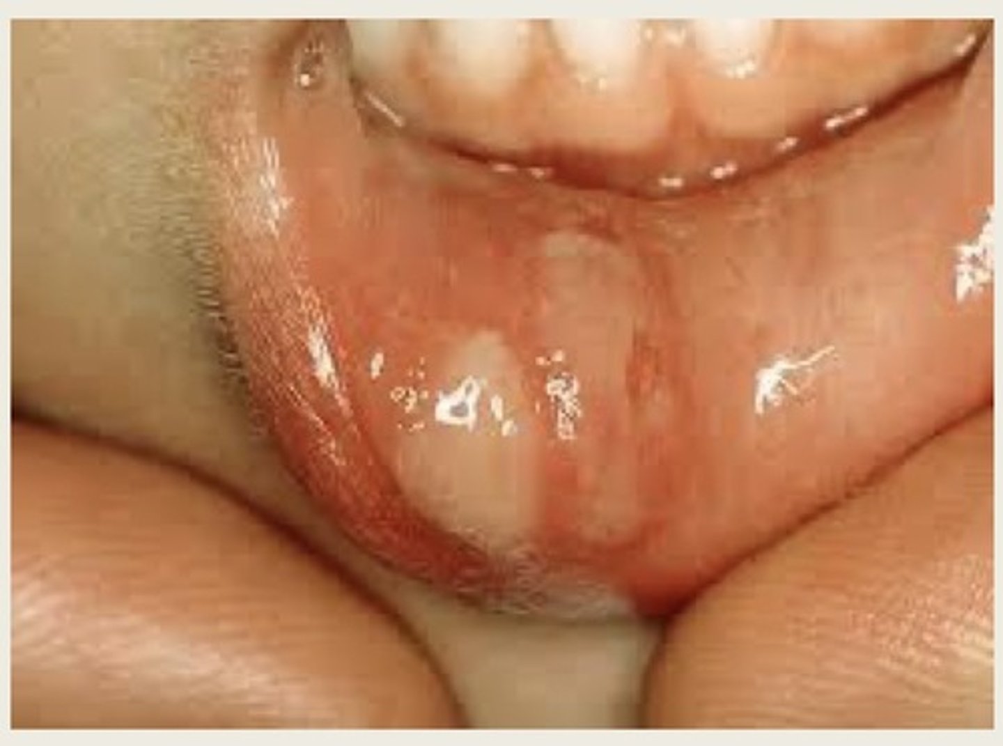 <p>Associated with neutropenia, that includes painful mouth ulcers, gum infections, periodontal disease.</p>