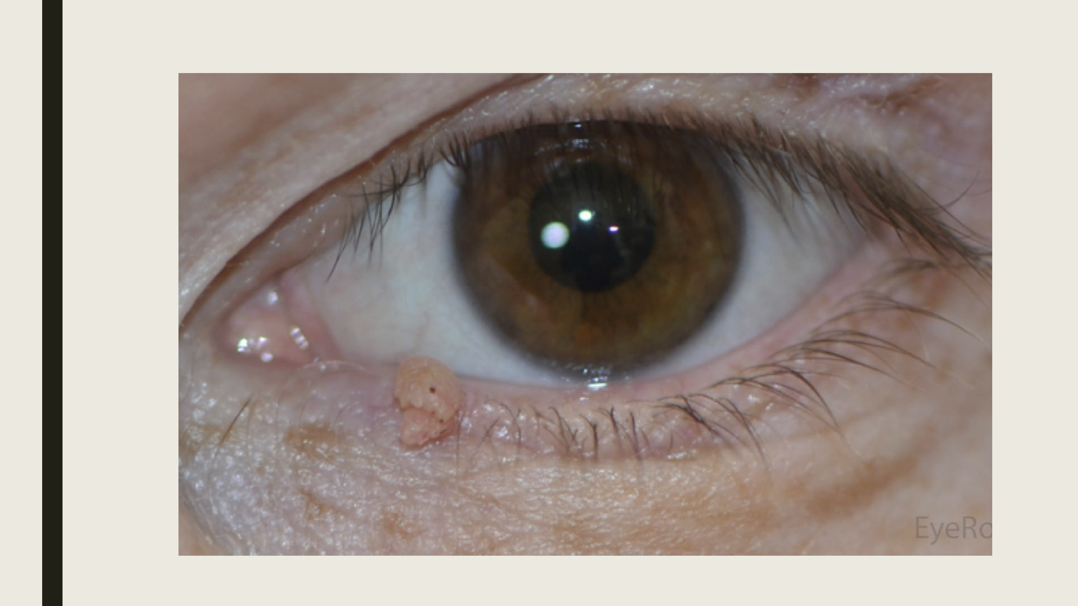 <p>Excision, oral antivirals will not work. </p>