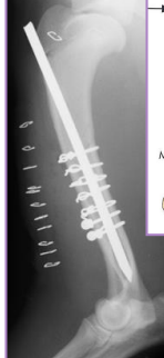 <ul><li><p>spica splints required! </p></li><li><p><span style="background-color: transparent;"><strong><span>Considerations: </span></strong></span></p><ul><li><p><span style="background-color: transparent;"><strong><span>Radial n.:</span></strong><span> lateral/superficial to brachiali muscle</span></span></p></li></ul></li><li><p><span style="background-color: transparent;"><strong><span>Proximal Physeal Fractures</span></strong></span></p><ul><li><p><span style="background-color: transparent;"><strong><span>Sig:</span></strong><span> growing dogs</span></span></p></li><li><p><span style="background-color: transparent;"><strong><span>Tx: </span></strong><span>parallel K-wires, cross the physis, heals fast</span></span></p></li></ul></li><li><p><span style="background-color: transparent;"><strong><span>Diaphyseal Fractures</span></strong></span></p><ul><li><p><span style="background-color: transparent;"><strong><span>Tx:</span></strong><span> fxn alignment</span></span></p><ul><li><p><span style="background-color: transparent;"><strong><span>Spiral:</span></strong><span> plate + screws, or IM pin + cerclage </span></span></p><ul><li><p><span style="background-color: transparent;"><span>pin sized to distal canal; </span><u><span>normograde/retrograde; lateral → medial</span></u></span></p></li></ul></li><li><p><span style="background-color: transparent;"><strong><span>Transverse: </span></strong><span>plate + screws, IM pin</span></span></p></li><li><p><span style="background-color: transparent;"><strong><span>Comminuted:</span></strong><span> plate + screws + IM pin, buttress, external fixator</span></span></p></li></ul></li></ul></li><li><p><span style="background-color: transparent;"><strong><span>Condylar Fractures:</span></strong><span> </span><u><span>Lateral</span></u><span> > medial</span></span></p><ul><li><p><span style="background-color: transparent;"><strong><span>Sig:</span></strong><span> </span><u><span>Young dogs w/ </span></u><strong><u><span>Salter-Harris IV,</span></u></strong><u><span> older dogs w/ incomplete ossification of humeral condyle</span></u></span></p></li><li><p><span style="background-color: transparent;"><strong><span>Tx:</span></strong></span></p><ul><li><p><span style="background-color: transparent;"><strong><span>Lateral condyle:</span></strong><span> lag screw + anti-rotational K-wire</span></span></p></li><li><p><span style="background-color: transparent;"><strong><span>T or Y fracture:</span></strong><span> bilateral plates + screws</span></span></p></li></ul></li></ul></li></ul><img src="https://knowt-user-attachments.s3.amazonaws.com/bce31c2e-6b7a-4cf3-990f-8d37e15280de.png" data-width="50%" data-align="center"><p></p>
