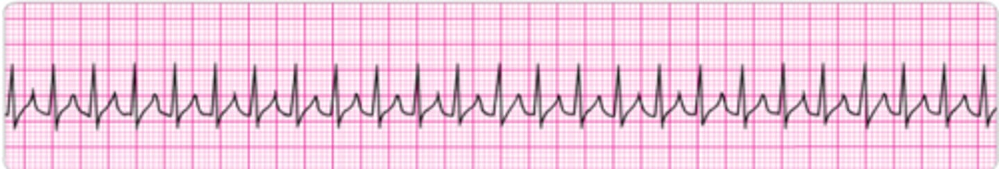 <p>Identify the rhythm.</p>