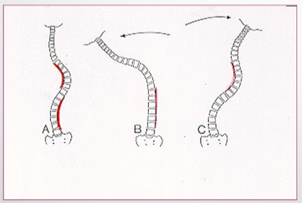 <ul><li><p>80% structural = fixed and fails to correct with lateral bending</p></li><li><p>20% functional (non-structural) = fluid and corrects with lateral bending</p></li></ul><p></p>