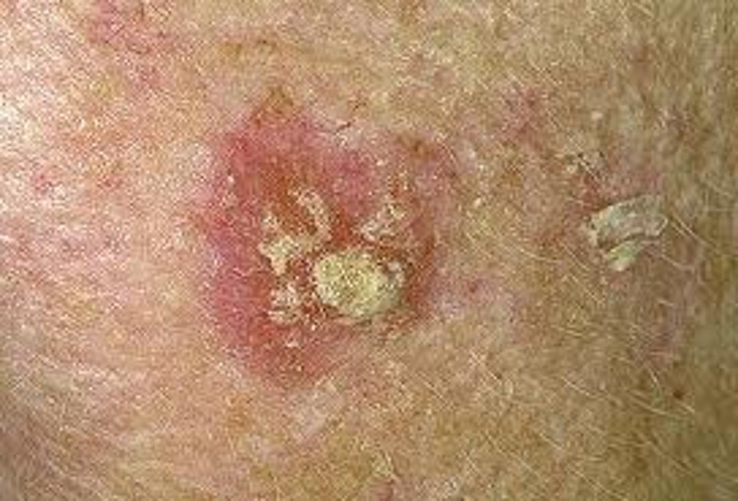 <p>precancerous skin growths</p><p>due to sun exposure</p><p>pink/red scaly</p><p>can lead to squamous cell carcinoma</p>