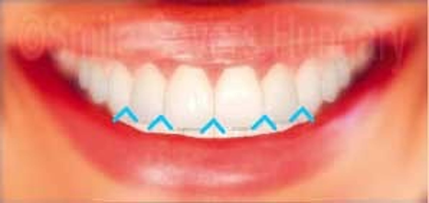<p>Surface of the tooth that is adjacent to the next tooth.</p>