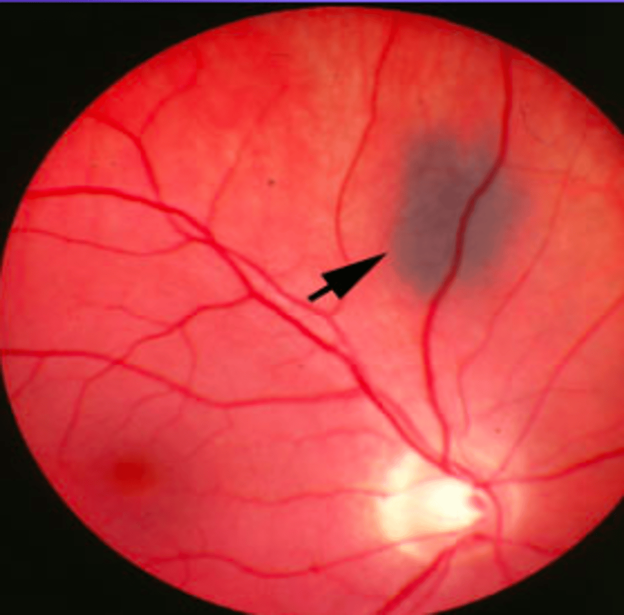 <p>Typically small, flat, grey lesions</p><p>• May be mottled (drusen and RPE variations)</p><p>• Variable shape - round to oval to irregular indistinct margins</p><p>• Usually no chorioretinal atrophy, no haloes around the lesion</p>