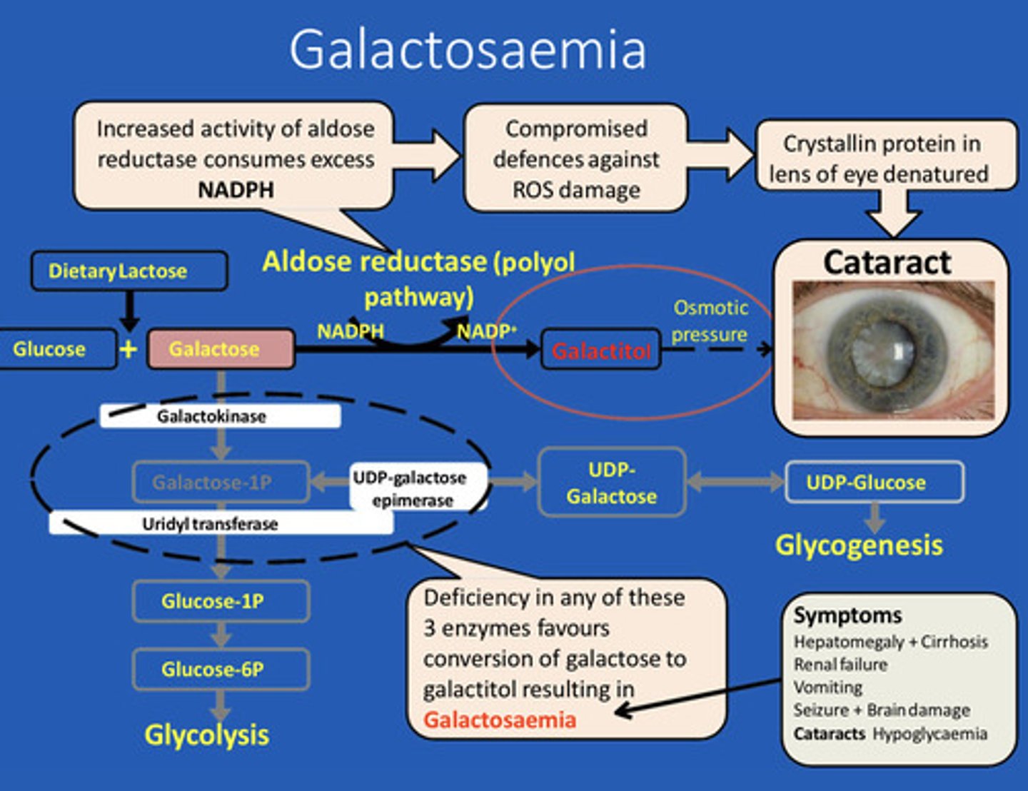 <p>Galactosaemia</p>