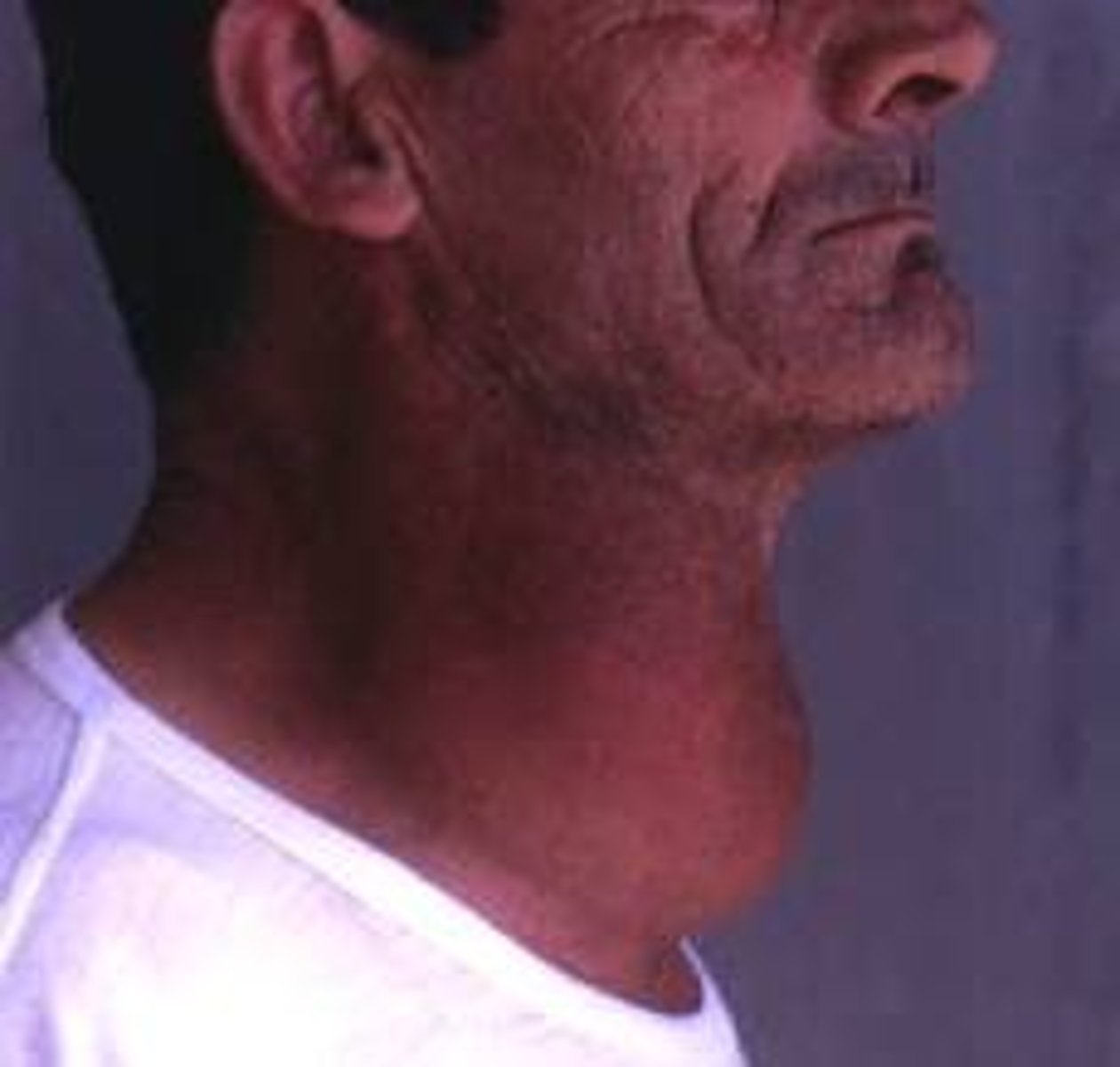 <p>Enlargement of the thyroid gland often caused by a lack of iodine.</p>