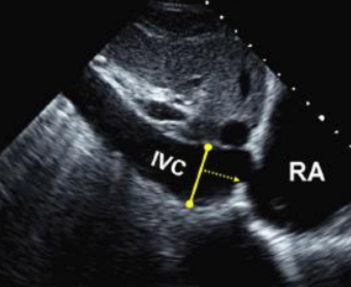 <p>Subcostal long</p>