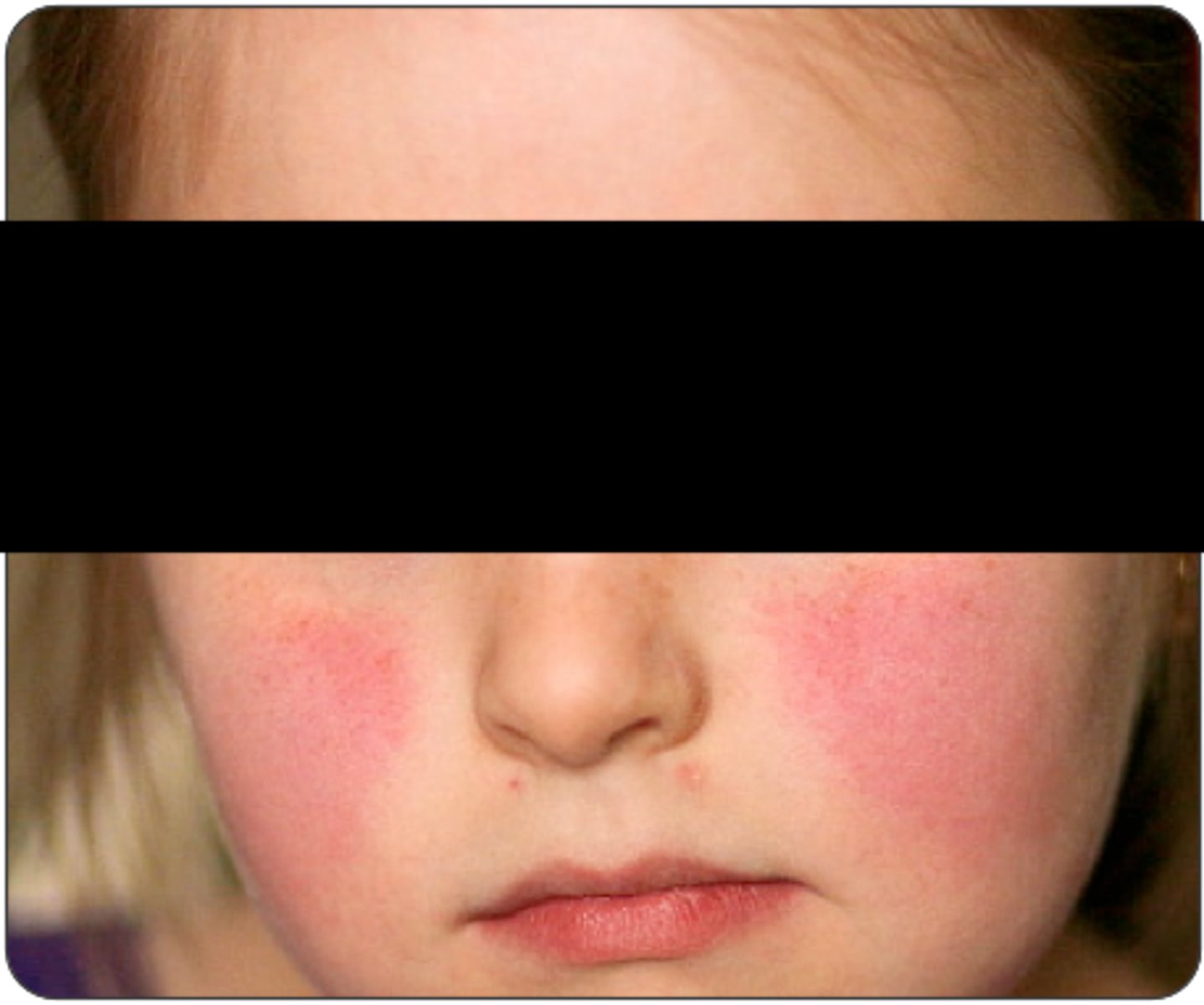 <p>A 4-year-old girl presents to the pediatrician’s office with her parents reporting a fever, cough, runny nose, nausea, and headache for the past 3 days. Her parents are worried because of the new-onset facial rash that developed today, which is shown above. Vital signs include an HR of 85 bpm, BP of 90/60 mm Hg, T of 100.4°F, RR of 26/min, and SpO2 of 99% on room air. What type of rash may develop on this patient after the facial rash resolves?</p><p>AErythematous, blanching, sandpaper-like papules throughout the body</p><p>BOval-shaped and rose-colored or light brown patch on the trunk</p><p>CReticulated or lacelike eruption on the trunk and extremities</p><p>DVesicles and pustules on the trunk that form a thick yellow crust</p>