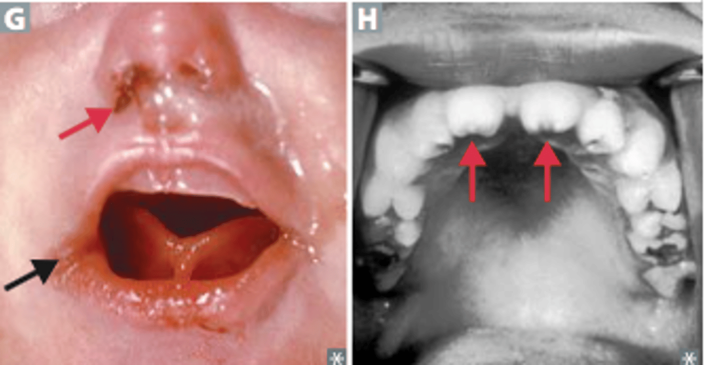 <p>Congenital Syphilis</p><p>occurs after the 16th week of gestation and affects virtually all fetal organs. If it is not treated, 25% of infected babies die before birth and another 30% shortly thereafter.</p>