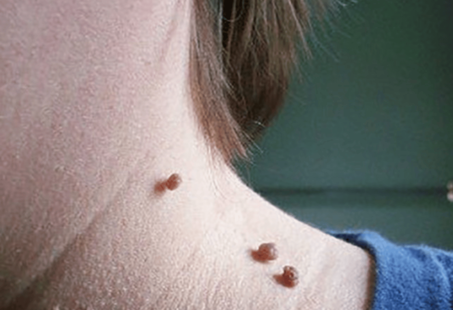<p>-skin tags or fibroepithelial polyps</p><p>-common, benign, pedunculated growths</p><p>-most commonly found in areas of frequent friction such as the eyelids, neck, axillae, and inguinal area</p><p>-usually asx but can become irritated by clothing or jewelry</p><p>-associated with increasing age, pregnancy, DM, and obesity</p>