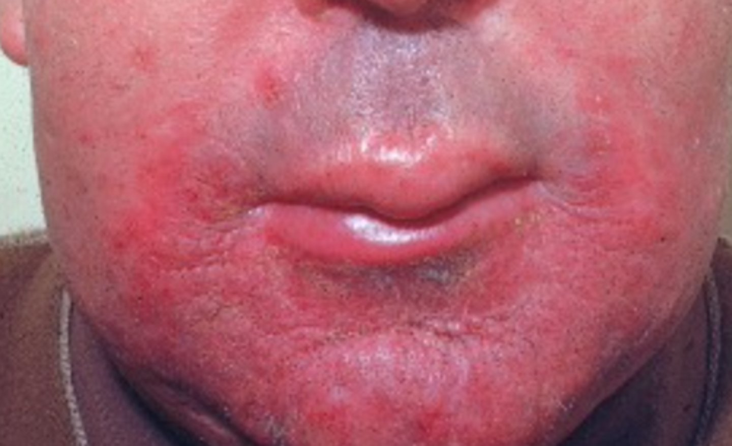 <p>Which organism likely caused this condition?</p>