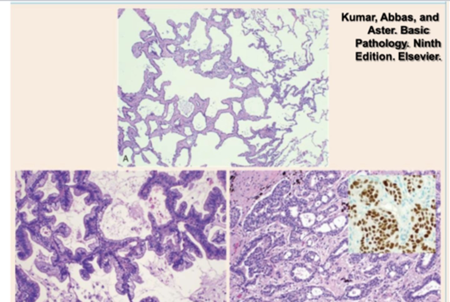 <p>adenocarcinoma</p>