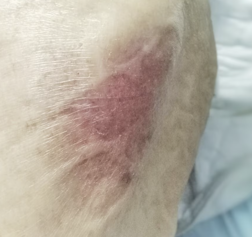 <p>what stage of pressure wound is this?</p>