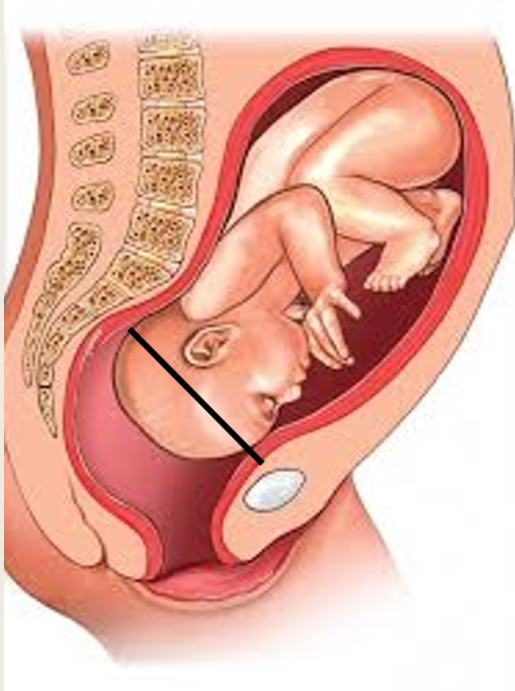 <ul><li><p>ertect/deflexed head</p></li><li><p>OF diameter presents (11.5cm)</p></li><li><p>Biparietal diameter (9.5cm)</p></li><li><p>OF diameter will descend the vagina and perineum more</p></li></ul><p></p>