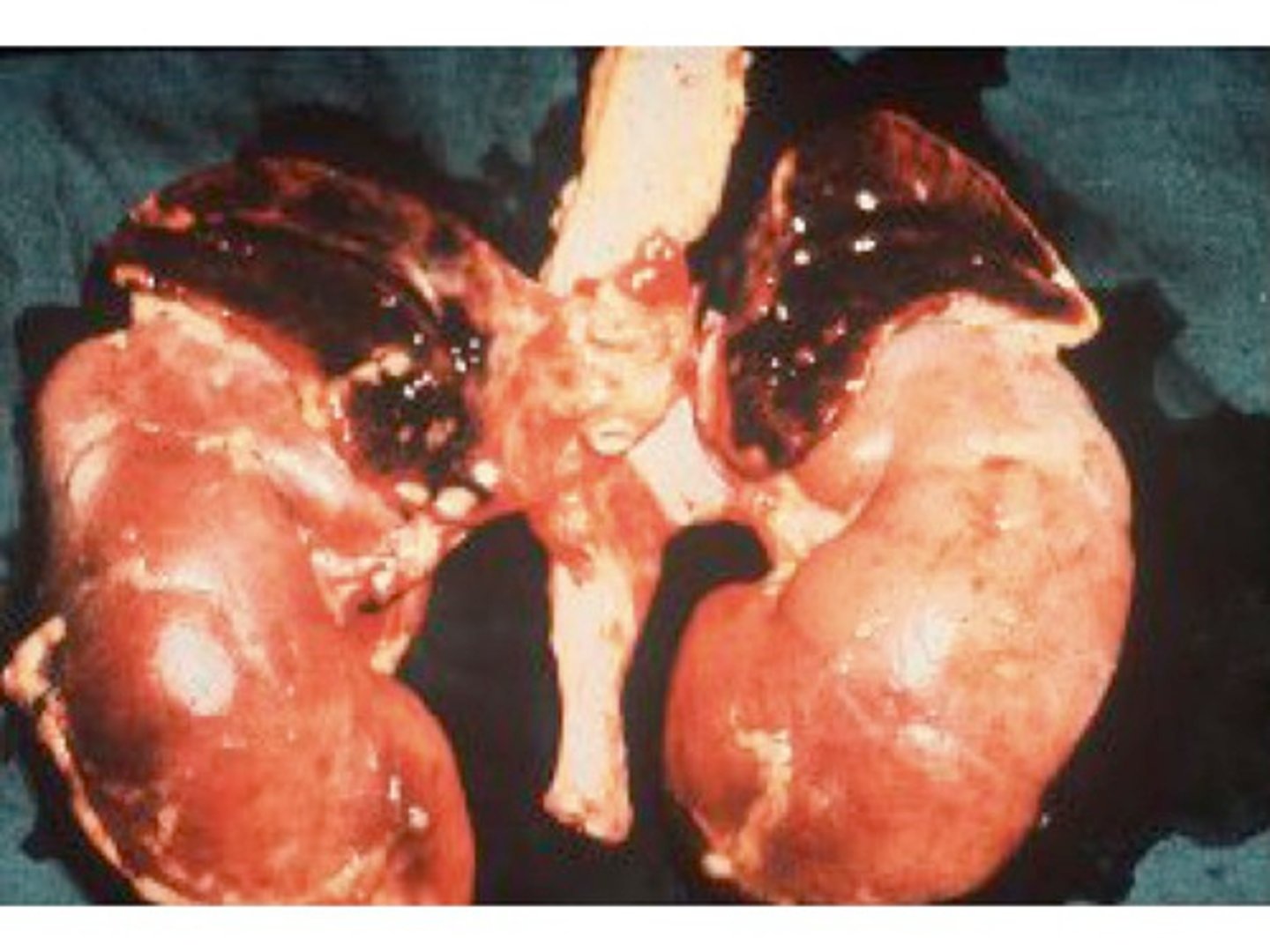 <p>Waterhouse-Frieerichsen syndrome (Neisseria meningitidis)</p>