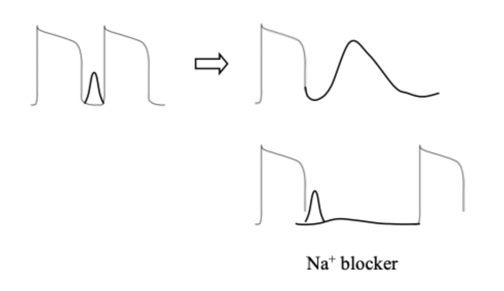 <p>(1) DAD treatment using a<strong> Na+ blocker</strong></p><p>(2) <strong>2 AP</strong></p><p>(3) <strong>3 beats</strong>.</p><img src="https://knowt-user-attachments.s3.amazonaws.com/6ea639c4-7470-4196-bd2a-458cc5b5e02b.png" data-width="100%" data-align="center"><p></p>
