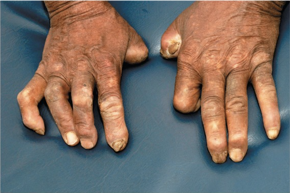 <p>this patient has a disease caused by an acid-fast positive bacterium that grows best between 30-35*C. what bacteria causes this disease and what form of the disease is it?</p>