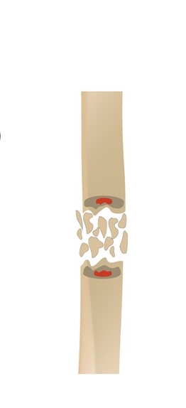 <p>comminuted fracture</p>