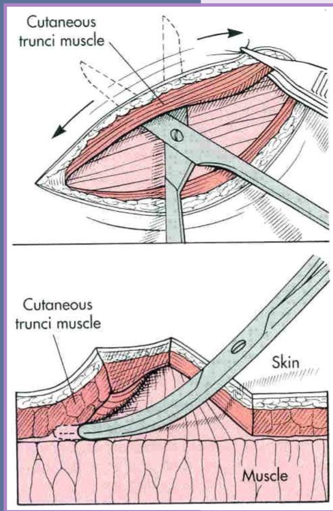 <ul><li><p>separate the skin and panniculus muscle (when present) from underlying subcutaneous tissue </p><ul><li><p>blunt and sharp scissor dissection </p></li></ul></li><li><p>simplest technique to relieve tension </p></li><li><p>maximizes elastic potential of skin edges </p></li><li><p>undermining - delayed wound closure </p><ul><li><p>separate granulation tissue from epithelium </p></li><li><p>caution!! dont get too aggressive </p></li></ul></li></ul><p></p>