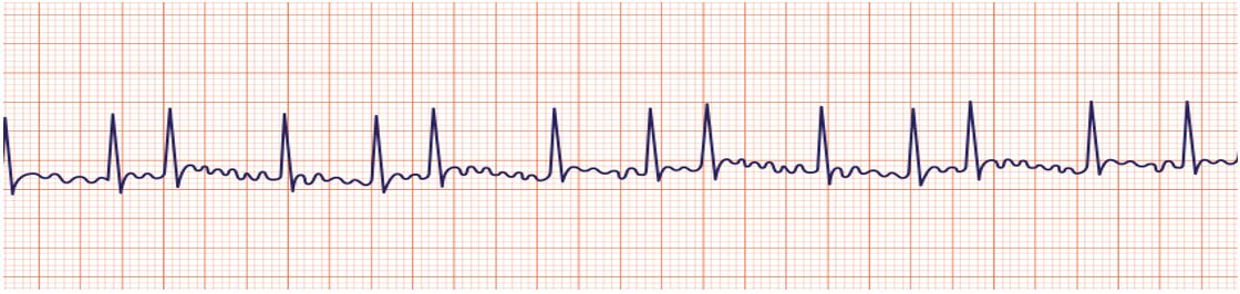 <p>WHAT IS THIS ECG READING?</p>