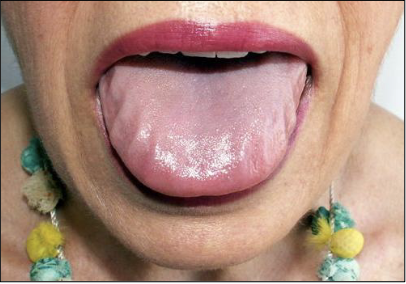 <p>Amyloidosis</p>