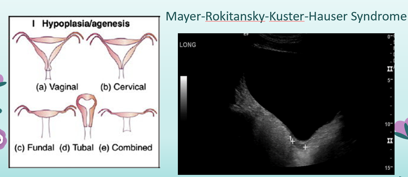<p>complete agenesis of uterus and vagina</p><ul><li><p>agenesis/ hypoplasia of uterus and/or vagina</p></li></ul><p>can have agenesis of only vagina with normal uterus</p>