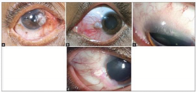 <p>The cornea and/or conjunctiva, with the conj of limbus region particularly susceptible.</p>