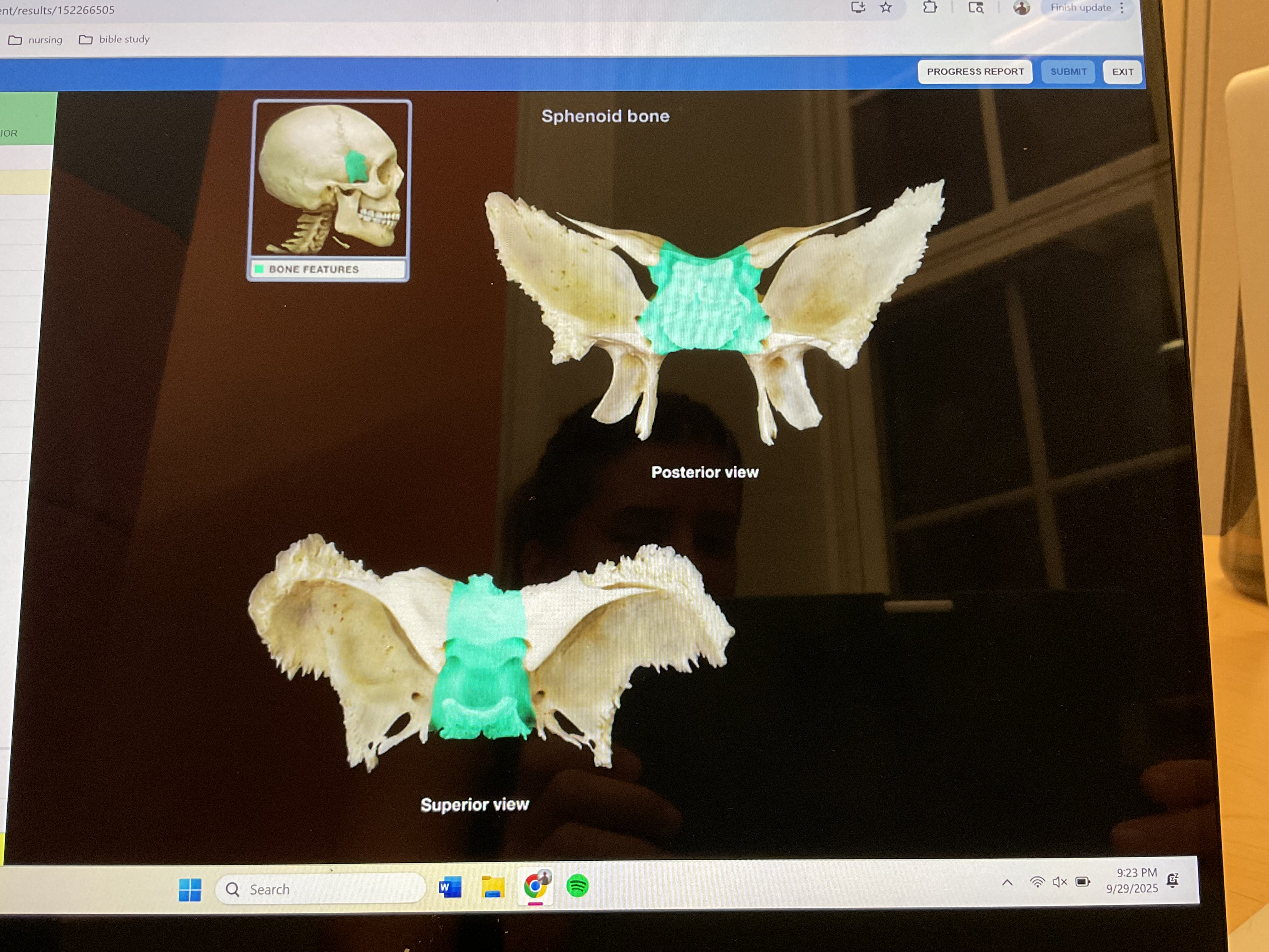 <p>Body of sphenoid bone </p>